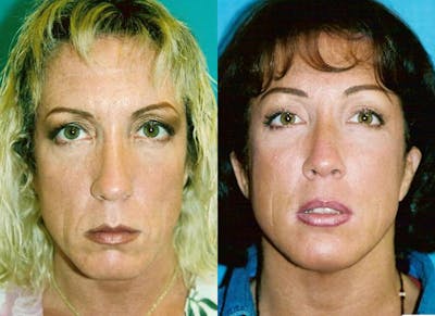 Facial Implant Before & After Gallery - Patient 122405712 - Image 1