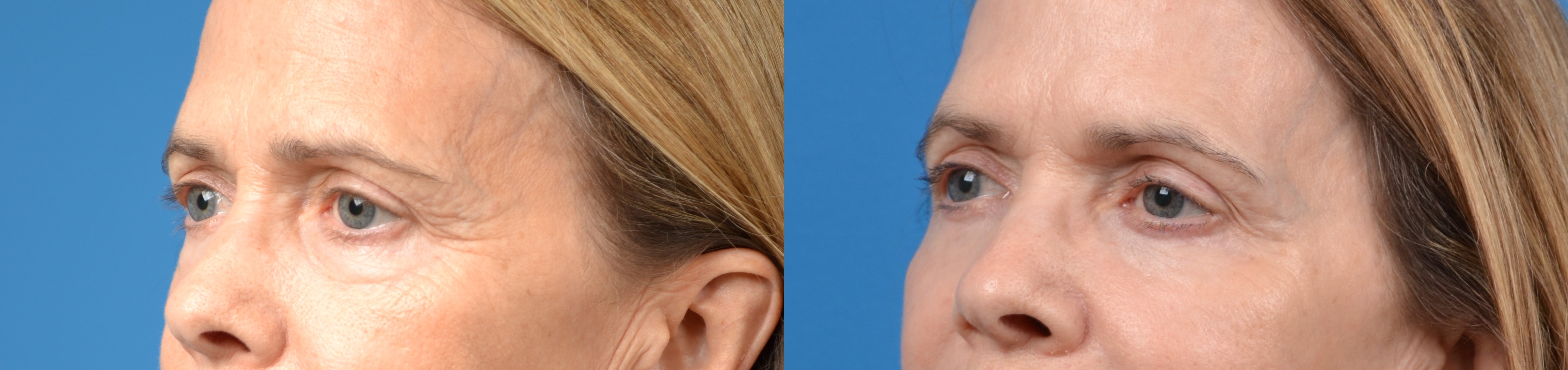 Eyelid Surgery Before & After Gallery - Patient 210789 - Image 1