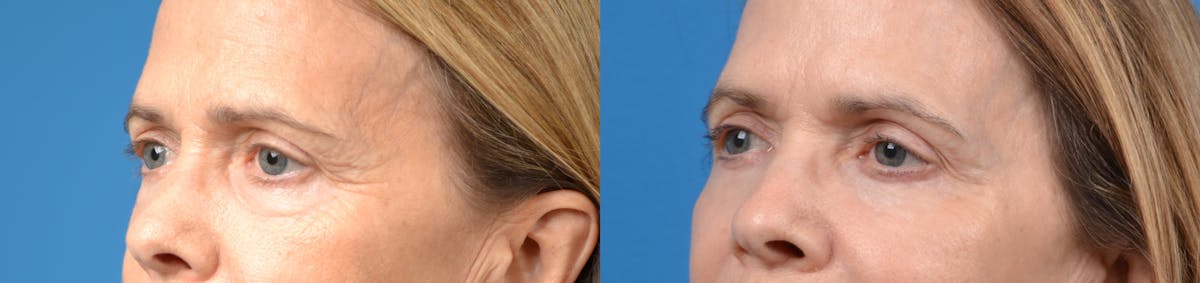 Eyelid Surgery Before & After Gallery - Patient 122405717 - Image 1