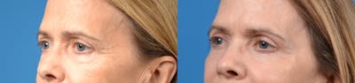 Eyelid Surgery Before & After Gallery - Patient 122405717 - Image 1