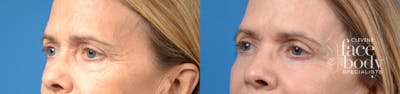 Eyelid Surgery Before & After Gallery - Patient 210789 - Image 1