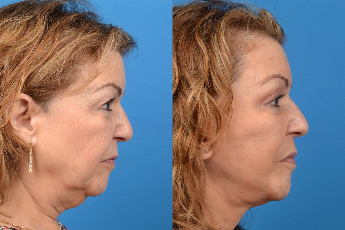 Facelift Before & After Gallery - Patient 122405713 - Image 5