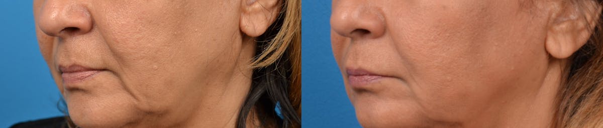 Dermal Fillers Before & After Gallery - Patient 122405715 - Image 2