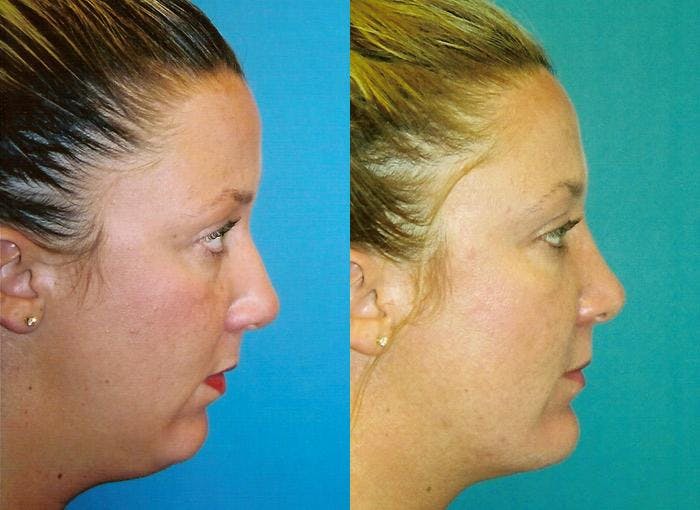 Facial Implant Before & After Gallery - Patient 122405714 - Image 1