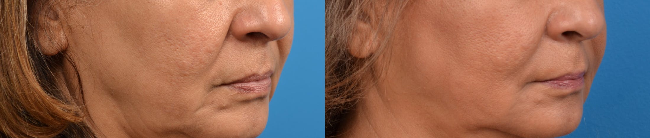 Dermal Fillers Before & After Gallery - Patient 122405715 - Image 3