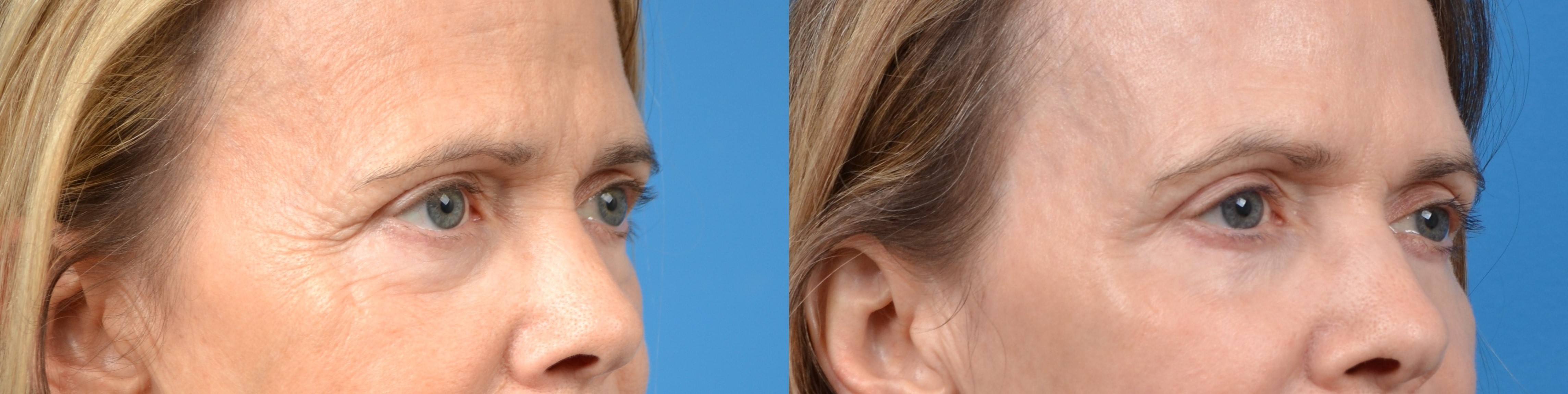 Eyelid Surgery Before & After Gallery - Patient 210789 - Image 2