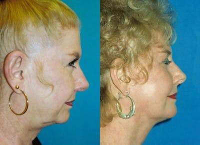 Facial Implant Before & After Gallery - Patient 122405716 - Image 1