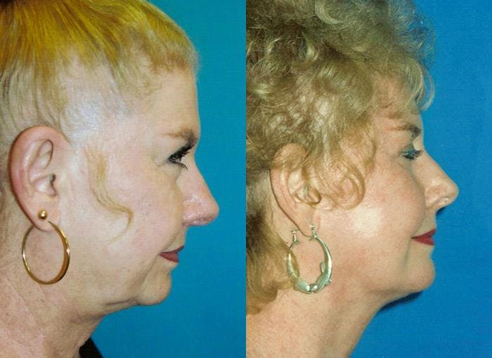 Facial Implant Before & After Gallery - Patient 122405716 - Image 1