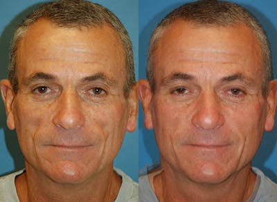 Dermal Fillers Before & After Gallery - Patient 122405718 - Image 1