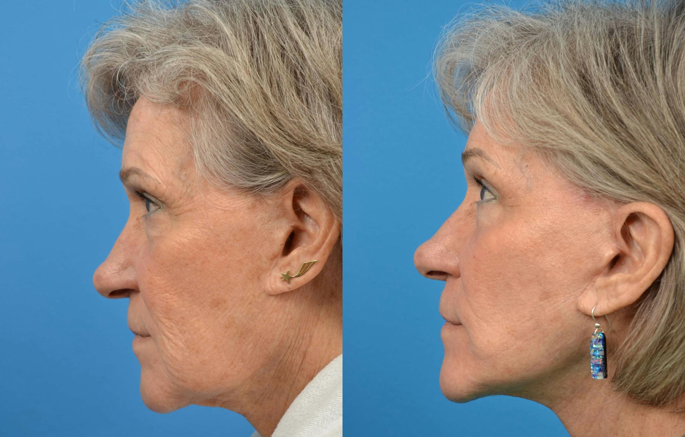 Facelift Before & After Gallery - Patient 122405727 - Image 1