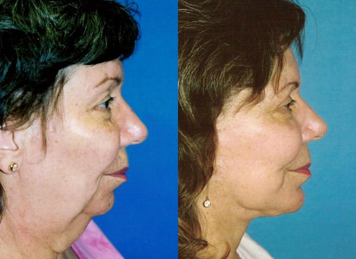 Facial Implant Before & After Gallery - Patient 122405719 - Image 1