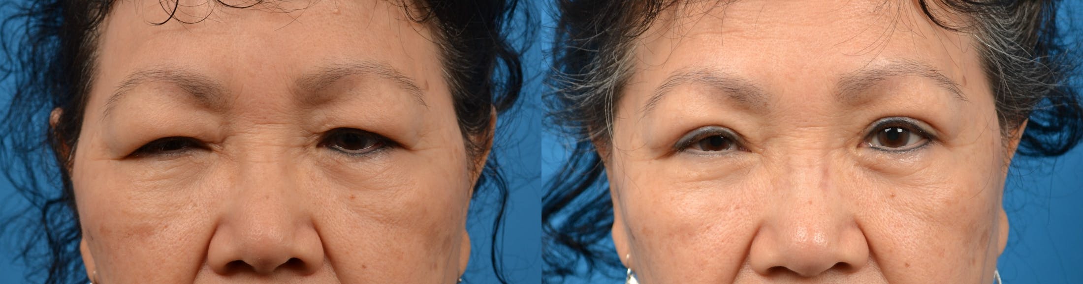 Eyelid Surgery Before & After Gallery - Patient 122405724 - Image 1