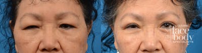 Eyelid Surgery Before & After Gallery - Patient 144362 - Image 1