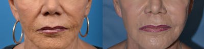 Dermal Fillers Before & After Gallery - Patient 122405725 - Image 1