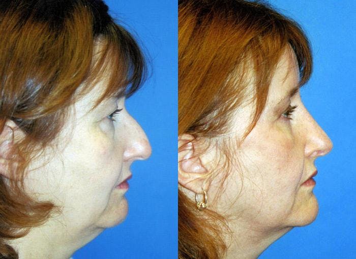 Facial Implant Before & After Gallery - Patient 122405721 - Image 1