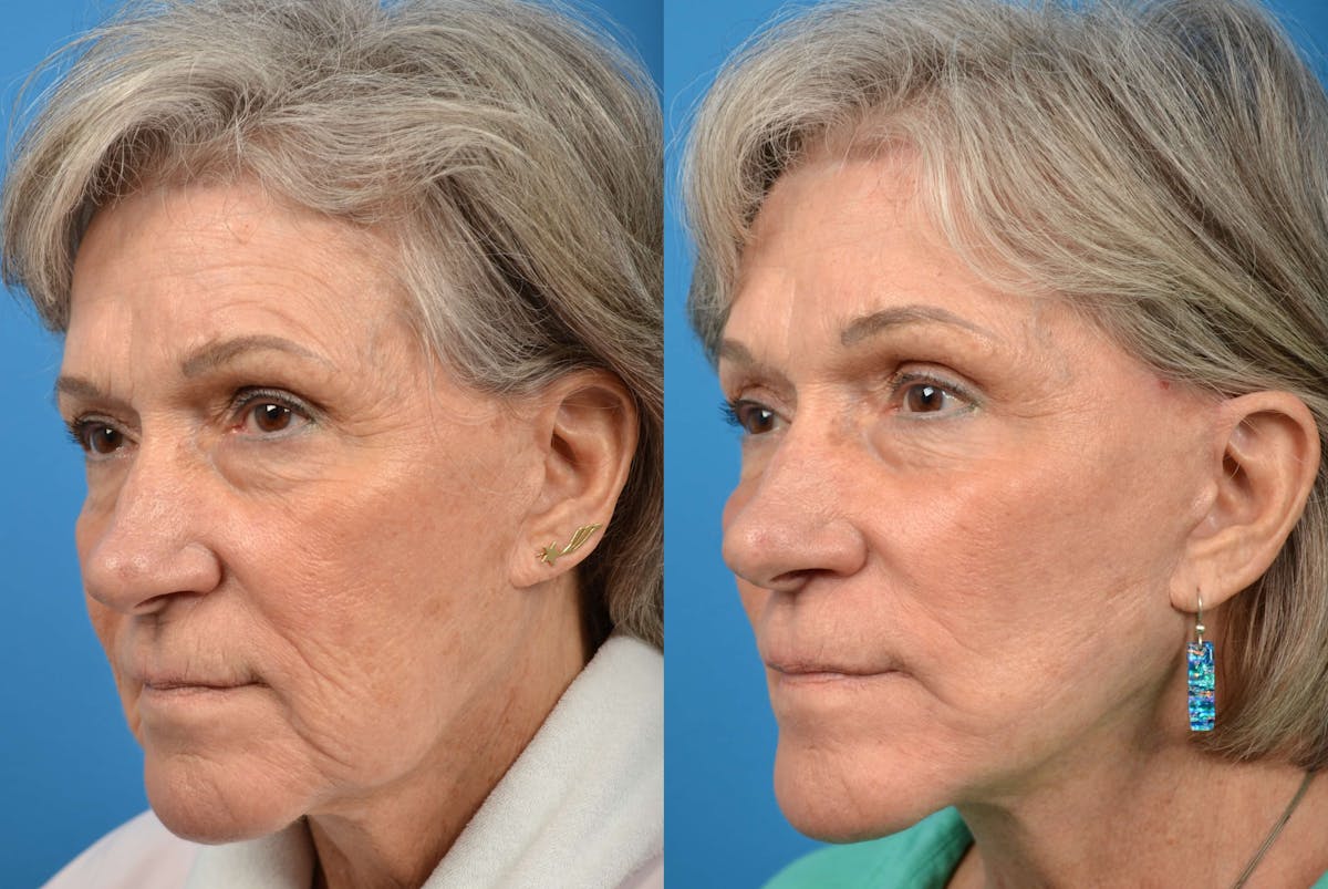 Facelift Before & After Gallery - Patient 122405727 - Image 2