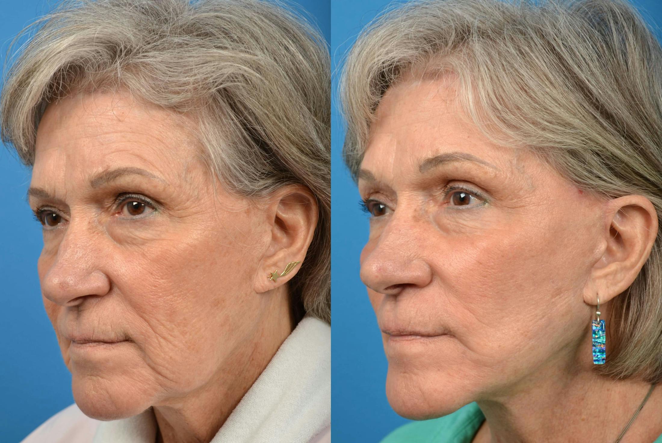 Facelift Before & After Gallery - Patient 122405727 - Image 2
