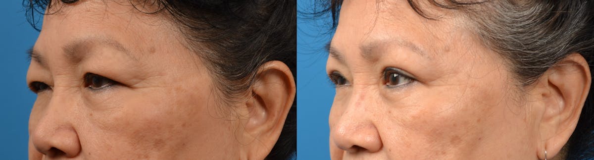 Eyelid Surgery Before & After Gallery - Patient 122405724 - Image 2