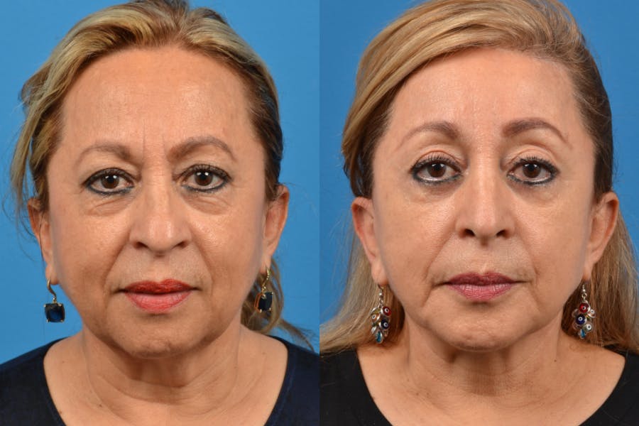 Facial Implant Before & After Gallery - Patient 122405733 - Image 1