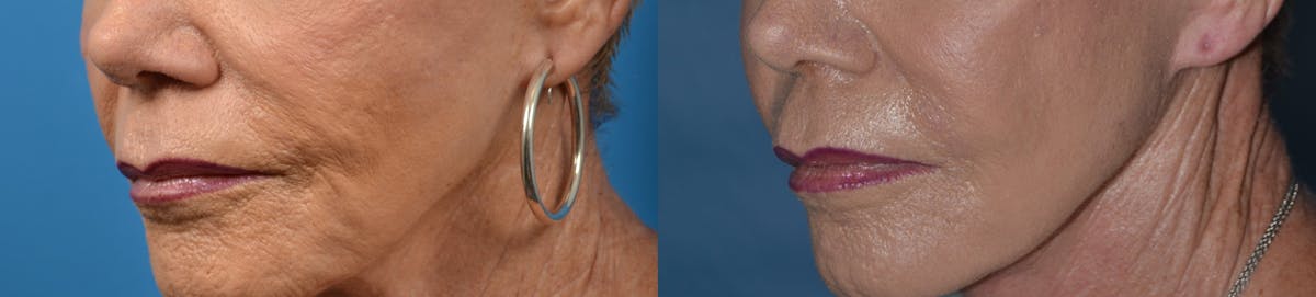 Dermal Fillers Before & After Gallery - Patient 122405725 - Image 2