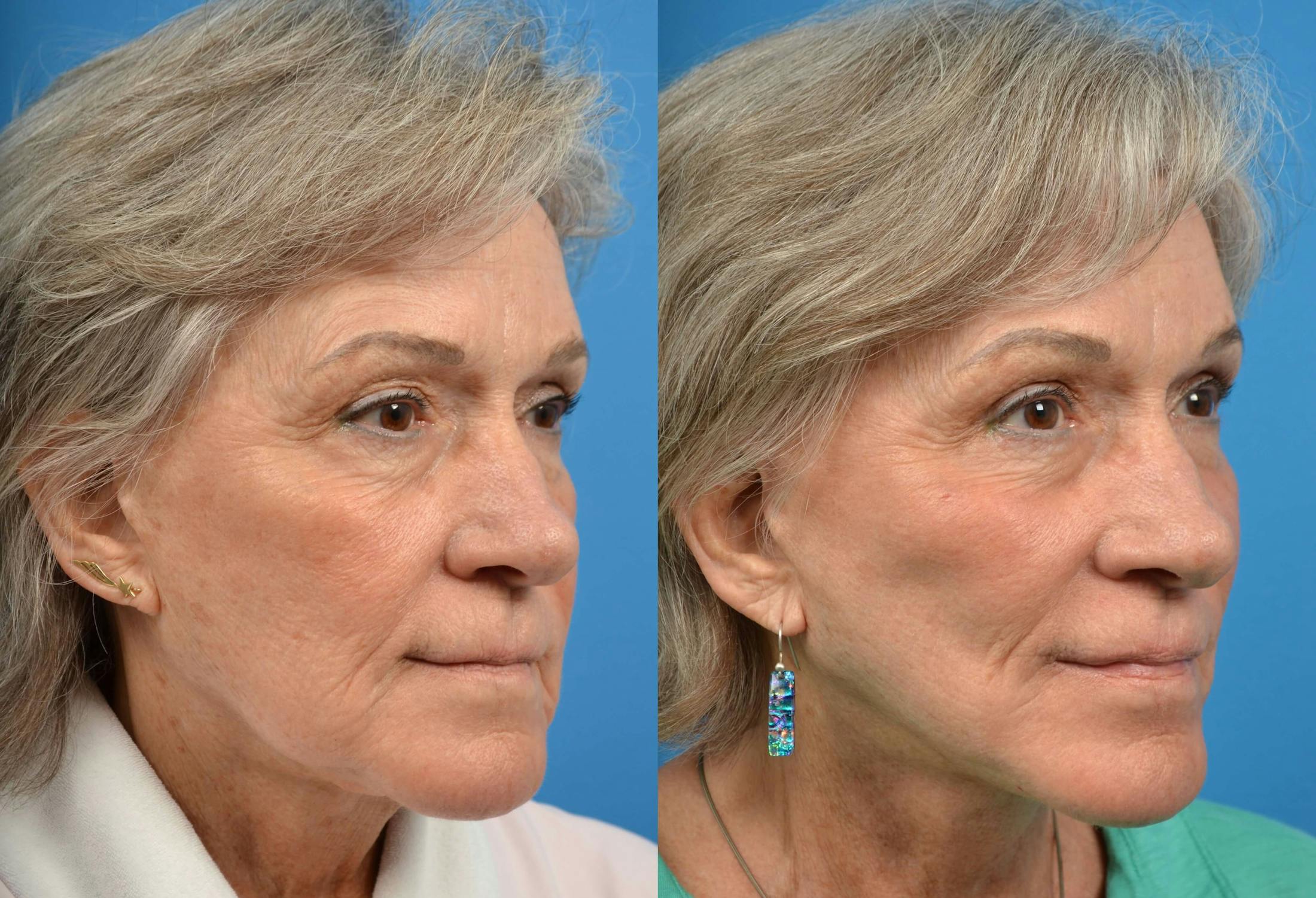 Facelift Before & After Gallery - Patient 122405727 - Image 3