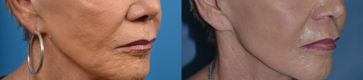 Dermal Fillers Before & After Gallery - Patient 122405725 - Image 3