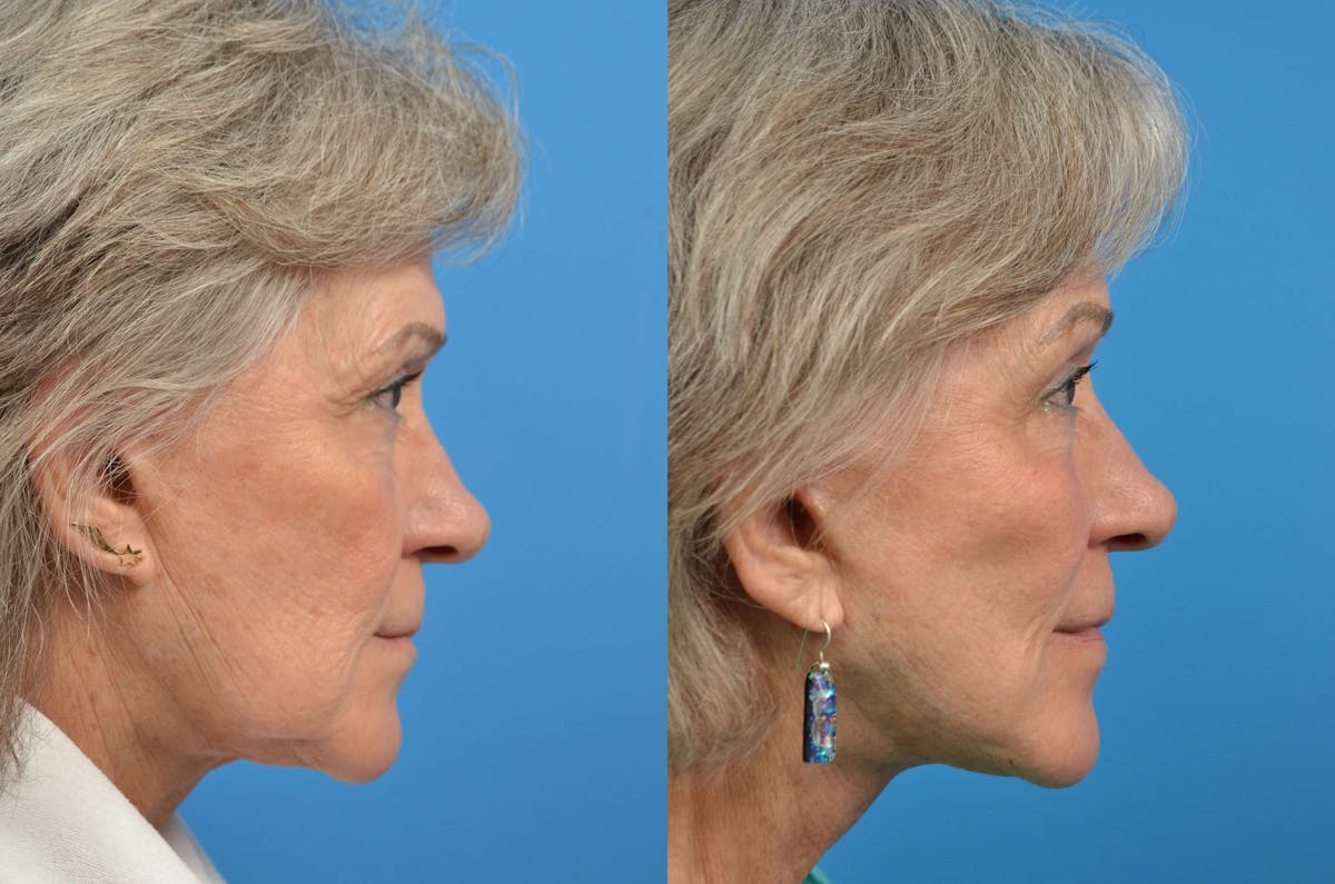 Facelift Before & After Gallery - Patient 122405727 - Image 4