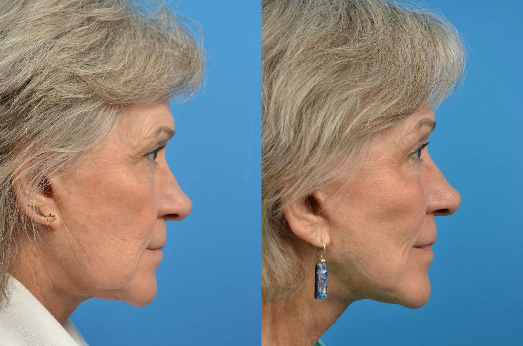 Facelift Before & After Gallery - Patient 122405727 - Image 4