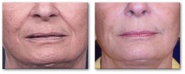 Dermal Fillers Before & After Gallery - Patient 122405729 - Image 1