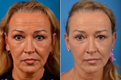 Facelift Before & After Gallery - Patient 122405739 - Image 1
