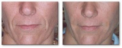 Dermal Fillers Before & After Gallery - Patient 122405732 - Image 1