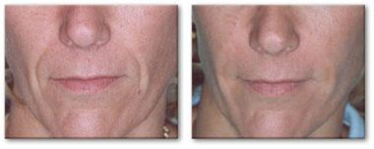 Dermal Fillers Before & After Gallery - Patient 122405732 - Image 1