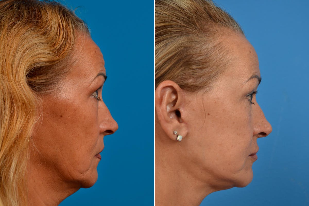 Facelift Before & After Gallery - Patient 122405739 - Image 2