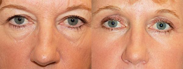 Eyelid Surgery Before & After Gallery - Patient 482692 - Image 1