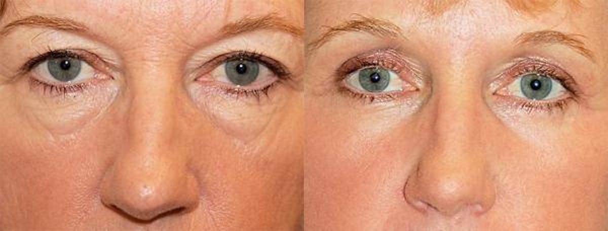 Eyelid Surgery Before & After Gallery - Patient 122405736 - Image 1