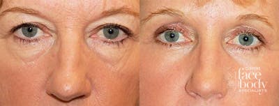 Eyelid Surgery Before & After Gallery - Patient 482692 - Image 1