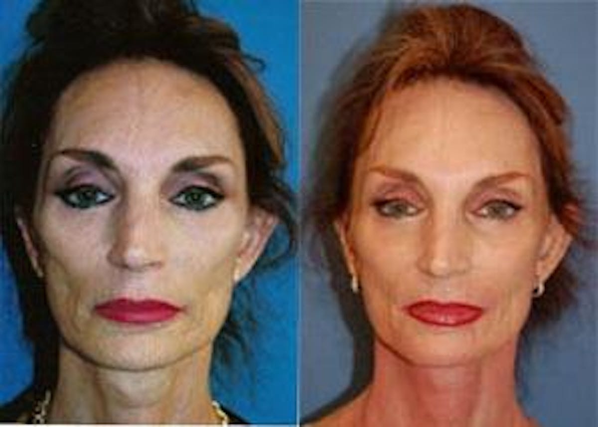 Dermal Fillers Before & After Gallery - Patient 122405734 - Image 1