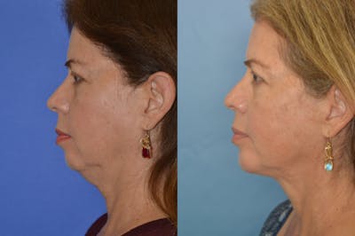 Facial Implant Before & After Gallery - Patient 122405735 - Image 1