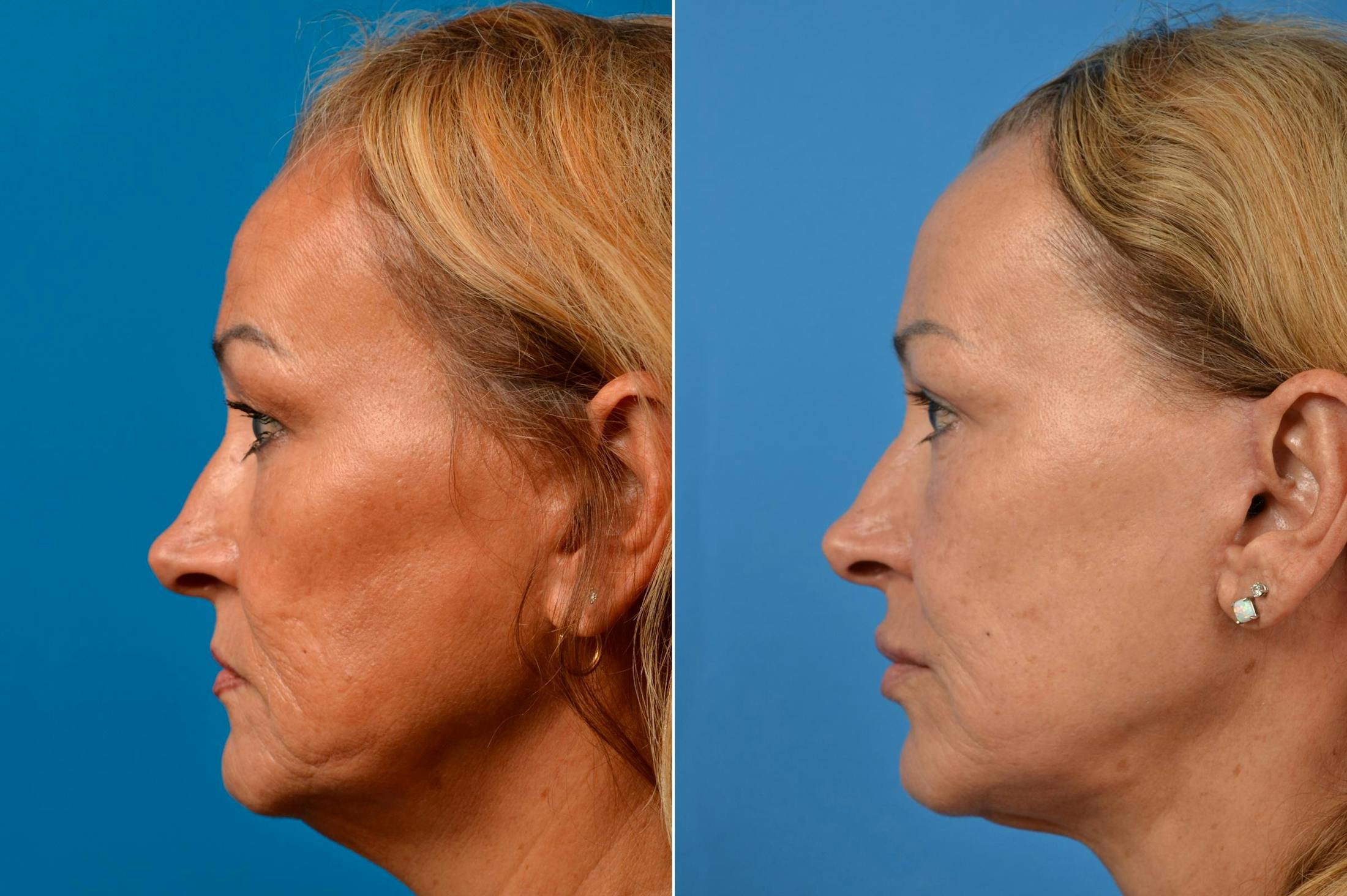 Facelift Before & After Gallery - Patient 122405739 - Image 3