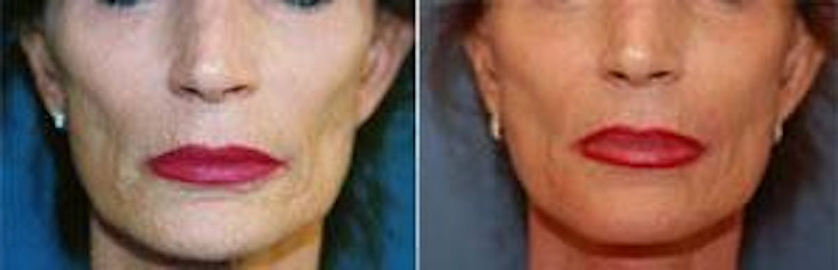 Dermal Fillers Before & After Gallery - Patient 122405734 - Image 2
