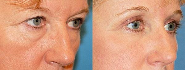 Eyelid Surgery Gallery - Patient 122405736 - Image 2