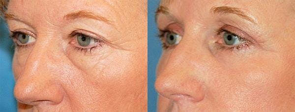 Eyelid Surgery Before & After Gallery - Patient 122405736 - Image 3