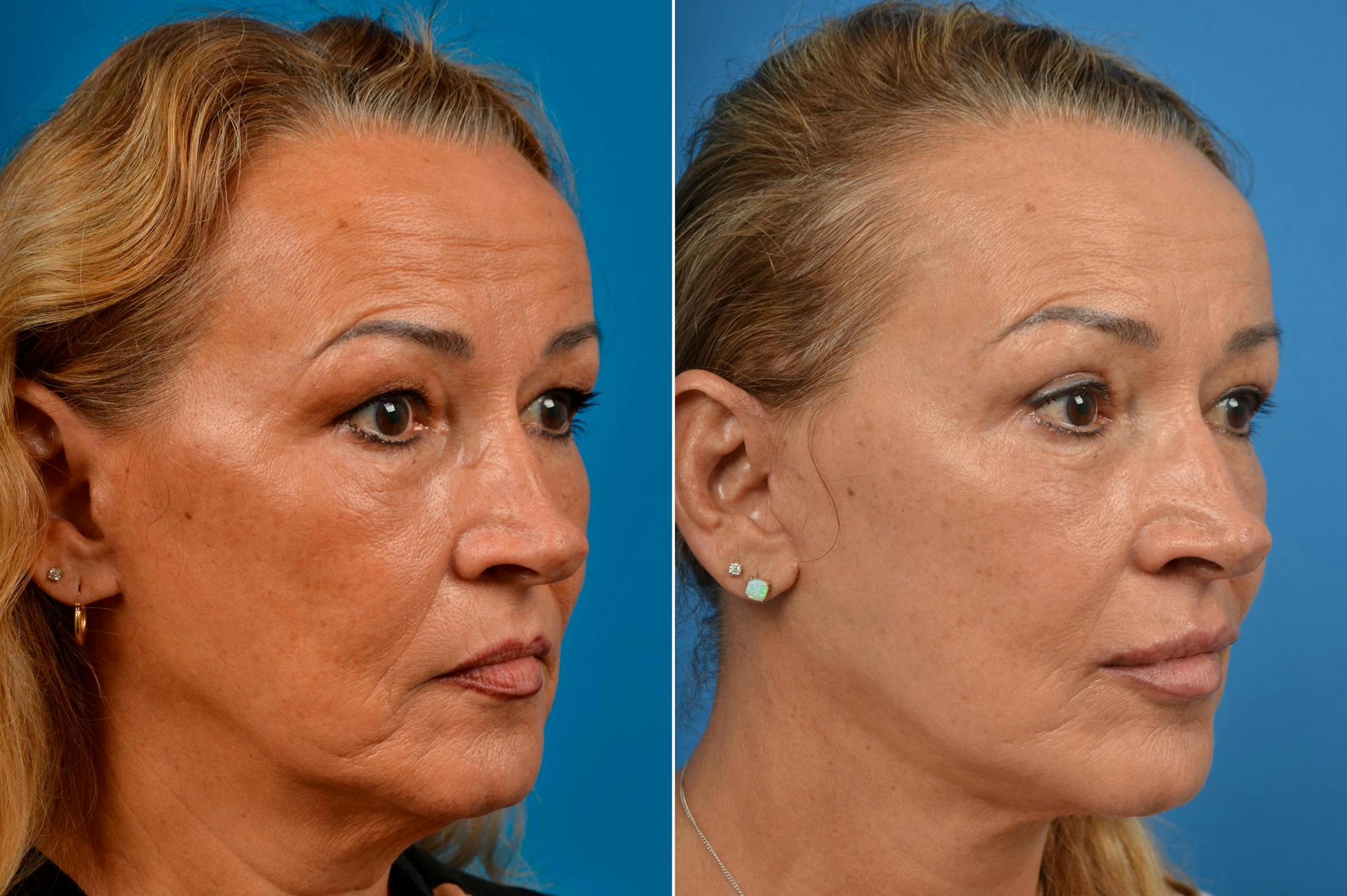 Facelift Before & After Gallery - Patient 122405739 - Image 4