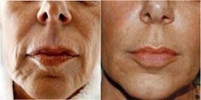 Dermal Fillers Before & After Gallery - Patient 122405737 - Image 1
