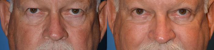 Eyelid Surgery Before & After Gallery - Patient 521519 - Image 1