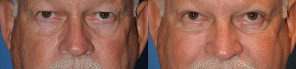 Eyelid Surgery Before & After Gallery - Patient 122405741 - Image 1