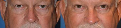 Eyelid Surgery Before & After Gallery - Patient 122405741 - Image 1