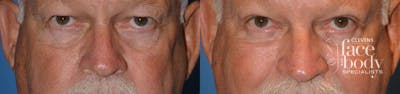 Eyelid Surgery Before & After Gallery - Patient 521519 - Image 1