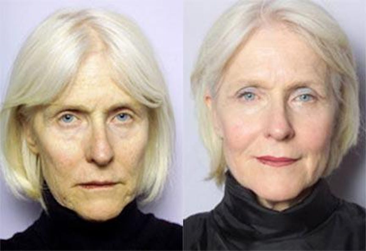 Dermal Fillers Before & After Gallery - Patient 122405738 - Image 1