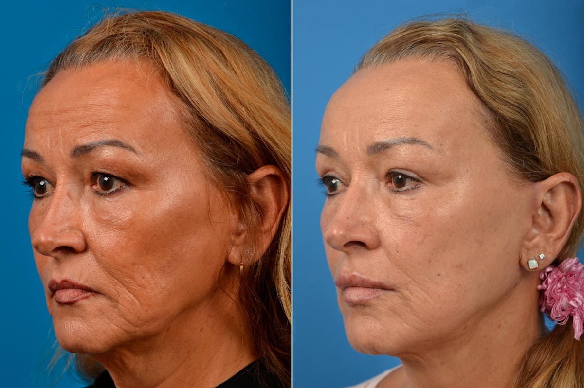 Facelift Before & After Gallery - Patient 122405739 - Image 5